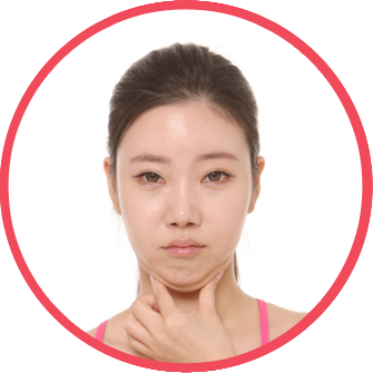 Double chin Liposuction