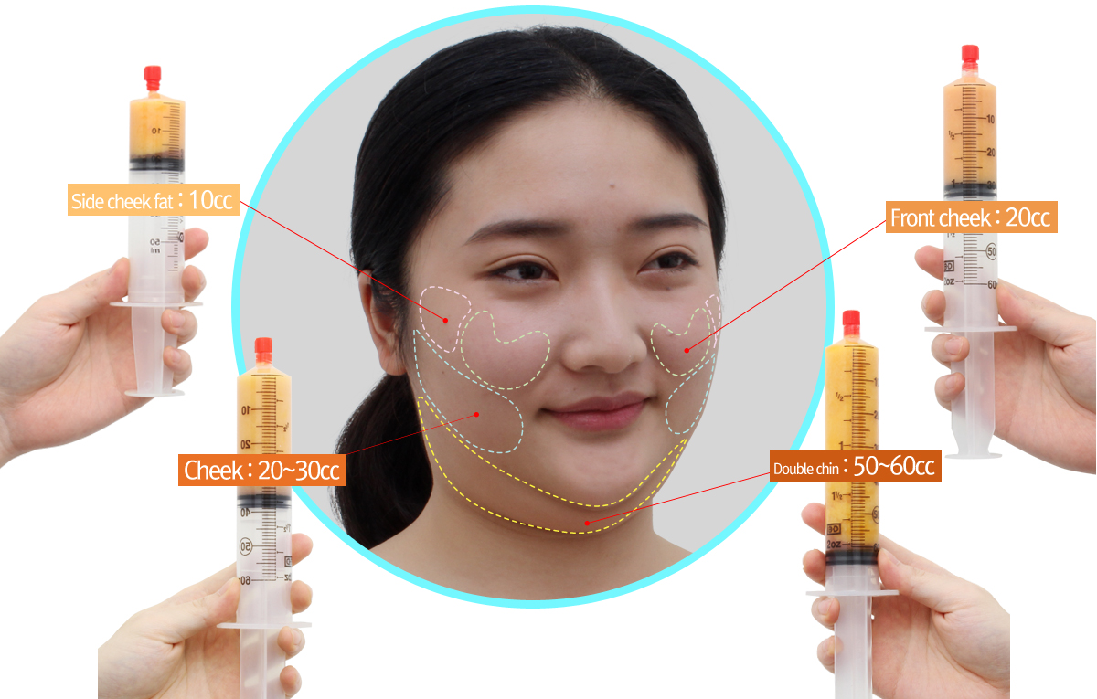 Double chin Liposuction