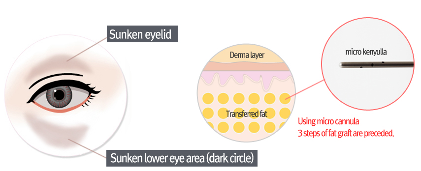 lower eyebag reposition