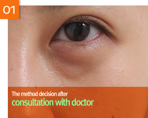 lower eyebag reposition