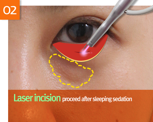lower eyebag reposition
