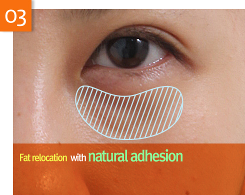lower eyebag reposition