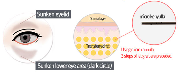 lower eyebag reposition