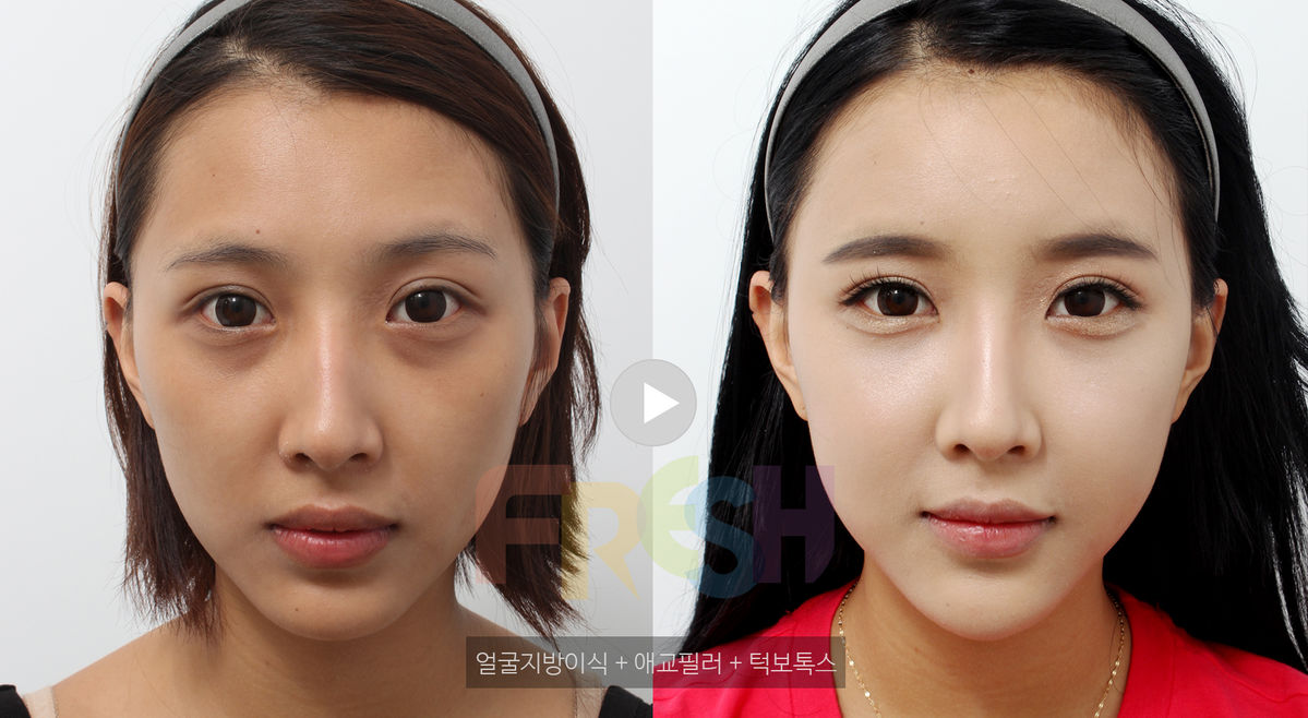 Facial Fat Grafting, Aegyo Filler, Jaw Botox : Korean Plastic Surgery ...