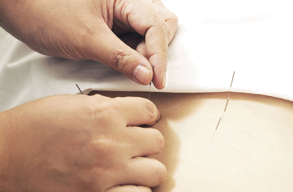 Pain Management Acupuncture