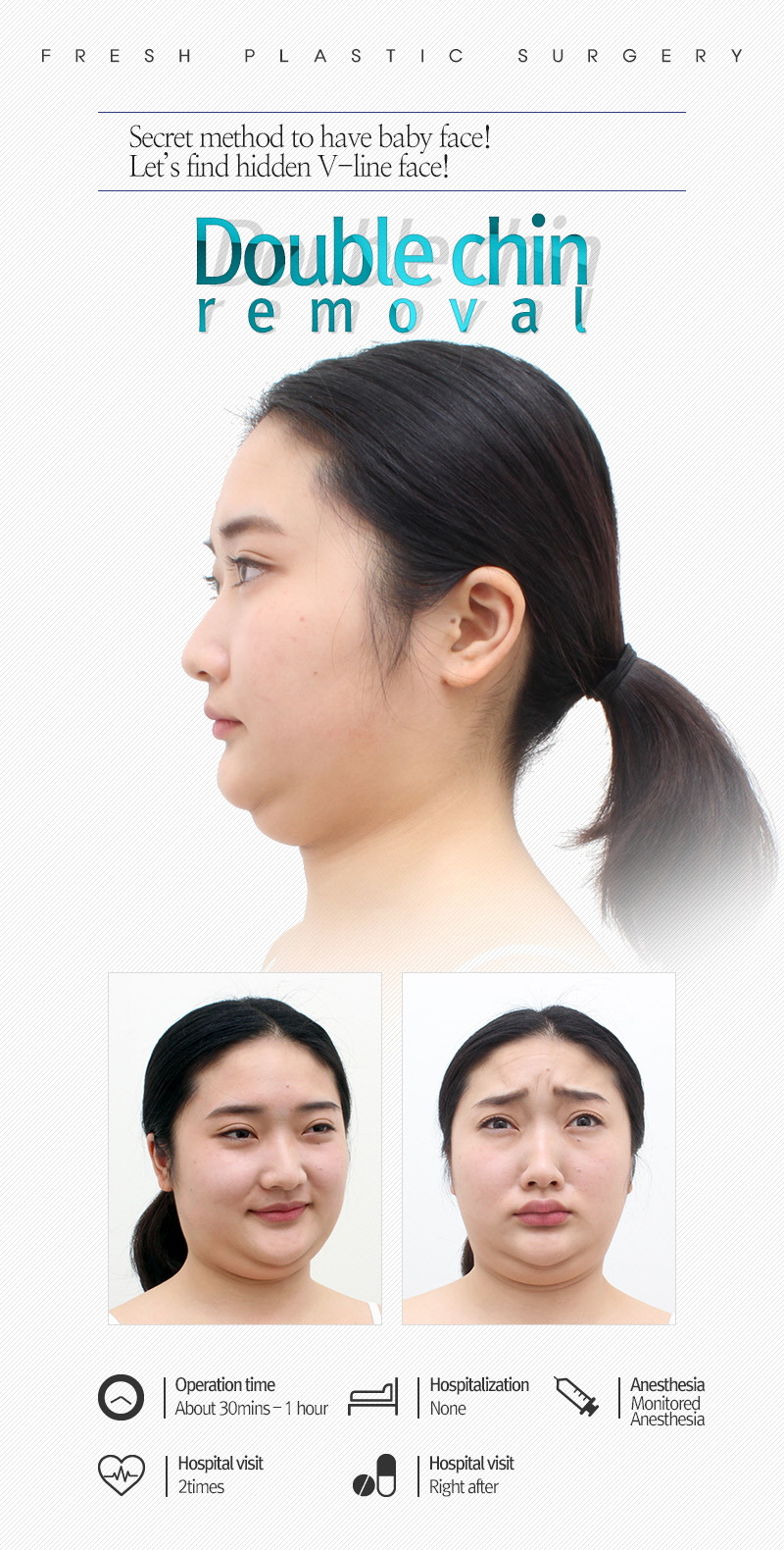 Double chin Liposuction