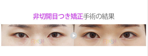 非切開目元矯正