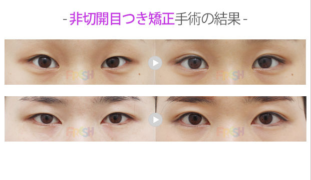 非切開目元矯正