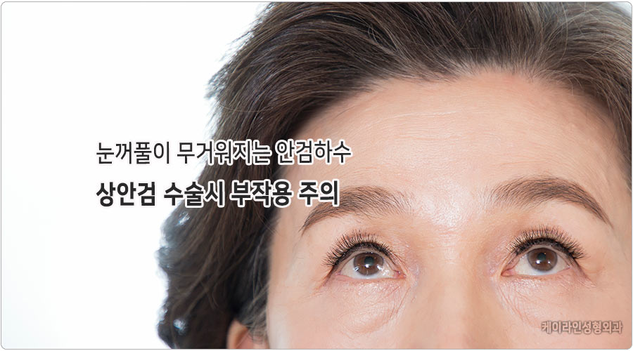 눈이 쳐지는 안검하수, 상안검 수술시 부작용 주의 : 눈성형센터 컬럼