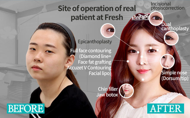 AccuZet V Contouring, Jaw Botox : Korean Plastic Surgery, Brazilian Butt  Lift