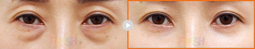 lower eyebag reposition