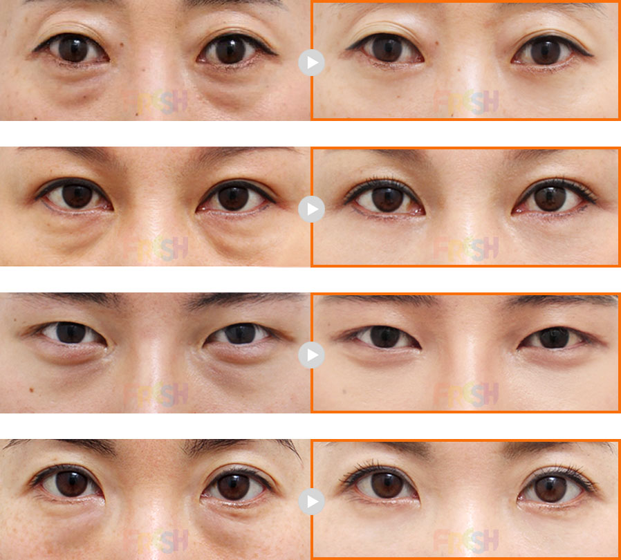 lower eyebag reposition