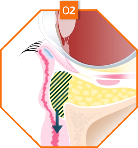 lower eyebag reposition