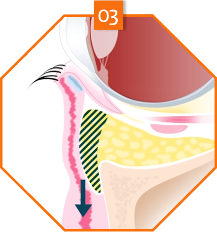 lower eyebag reposition