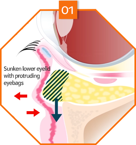 lower eyebag reposition