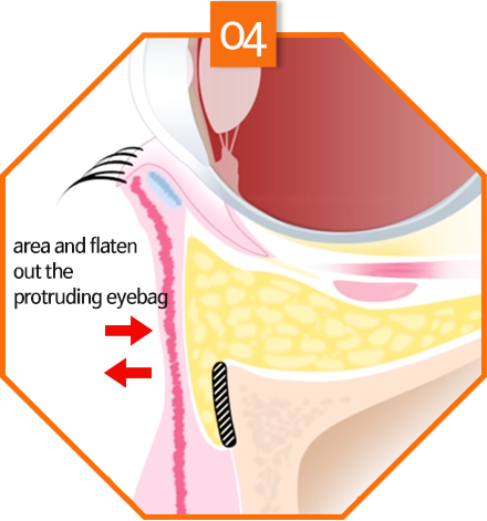 lower eyebag reposition