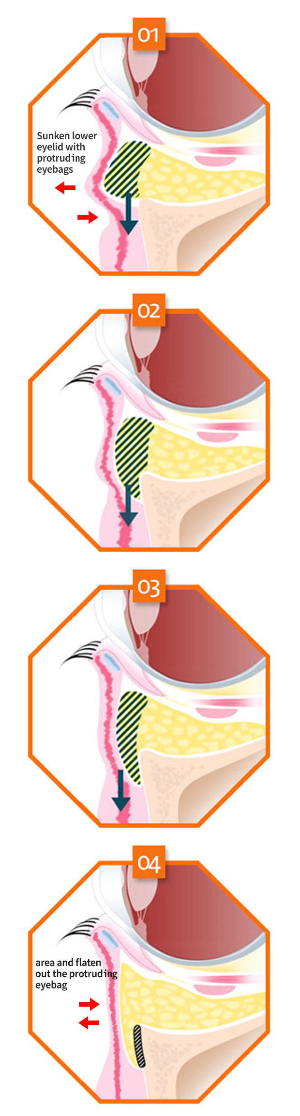 lower eyebag reposition
