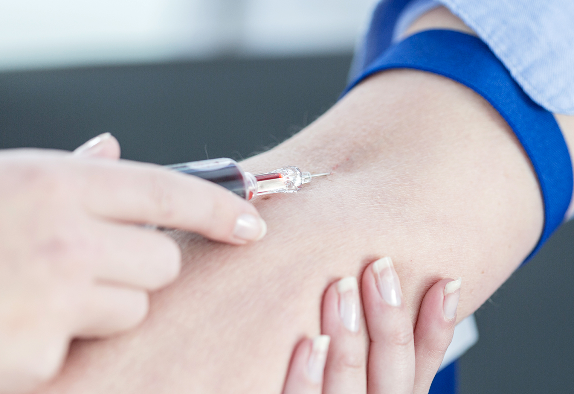 PRP주사 치료 알아보기