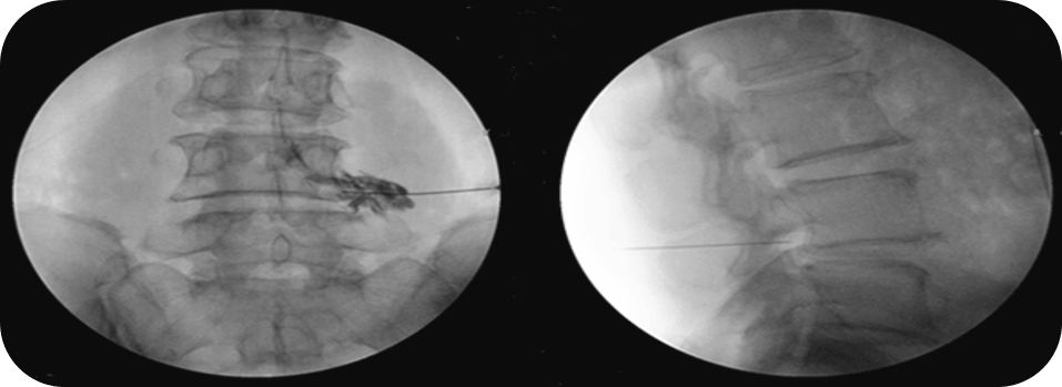 ▲ 방사선 투시장비(C-arm) 영상