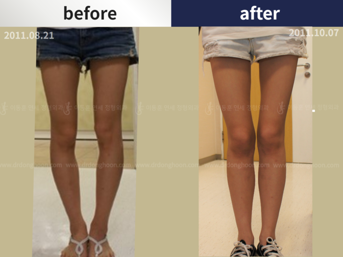 Tibial lengthening