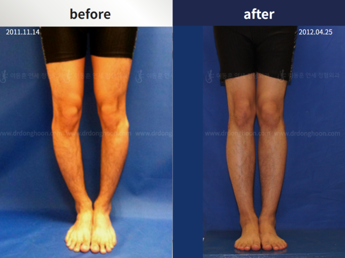 Tibial lengthening