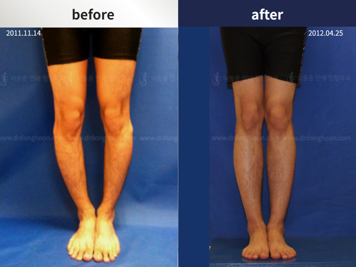 Tibial Lengthening + Bowlegs Correction + Protruded Fibular Head : CLL ...