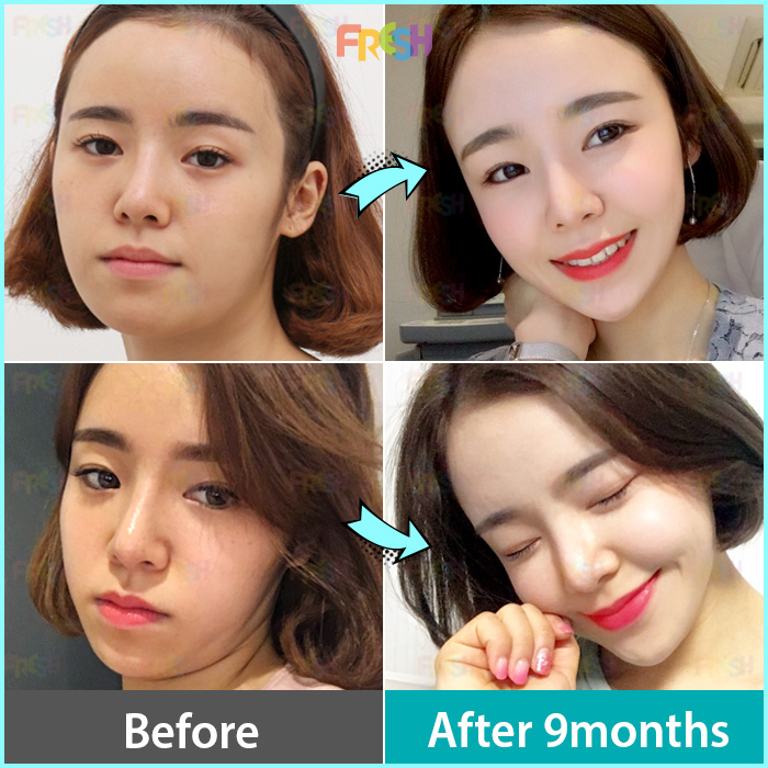 얼굴 지방이식 잘하는곳 쁘띠패드 인기있어 7