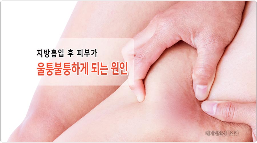 여백수술 지방흡입으로는 안되나 7