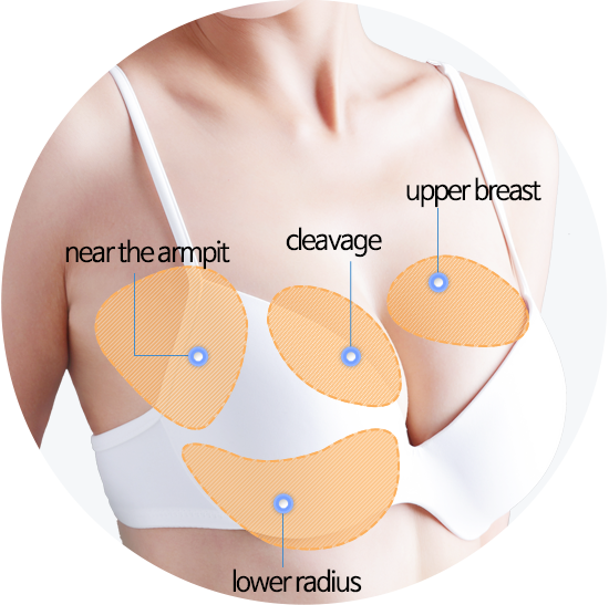 breast fat graft