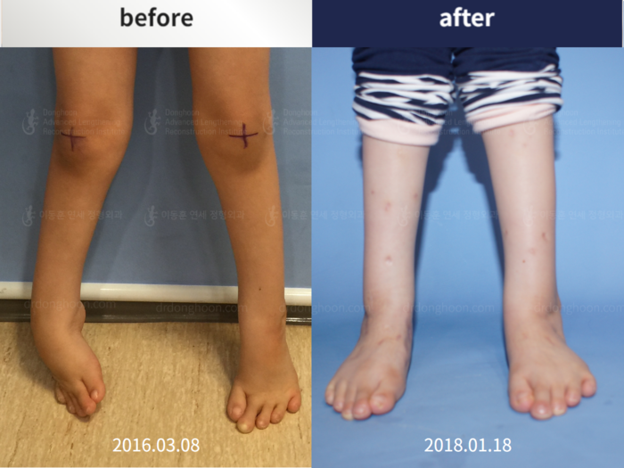 Congenital clubfoot