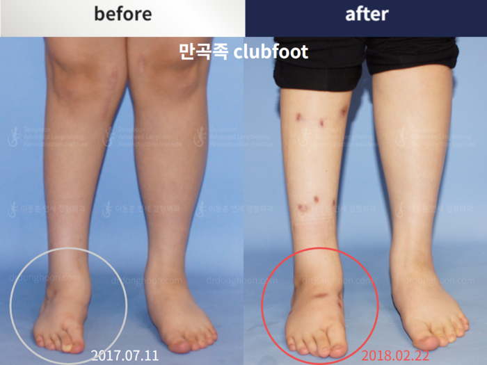 Congenital clubfoot