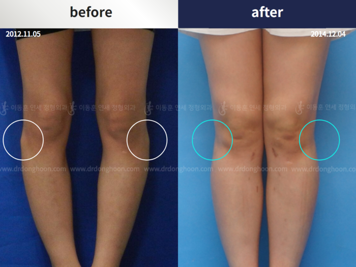 Protruded fibular head