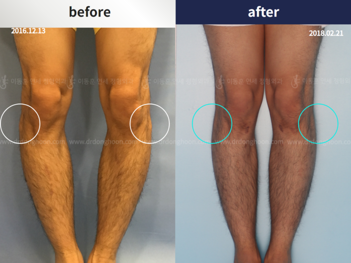 Protruded fibular head