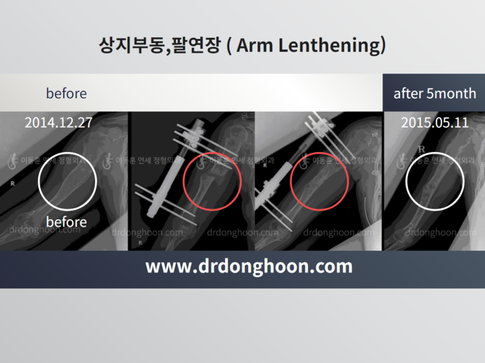 Arm lengthening