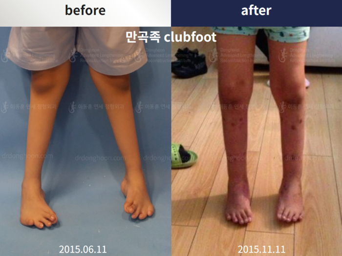 Congenital clubfoot