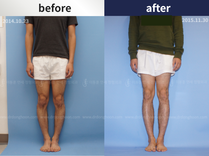 Tibial lengthening
