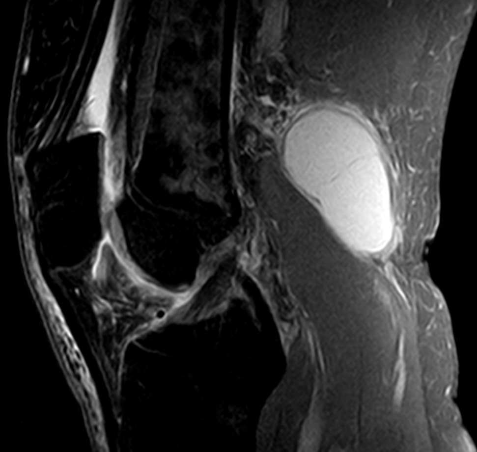 베이커씨낭종 MRI