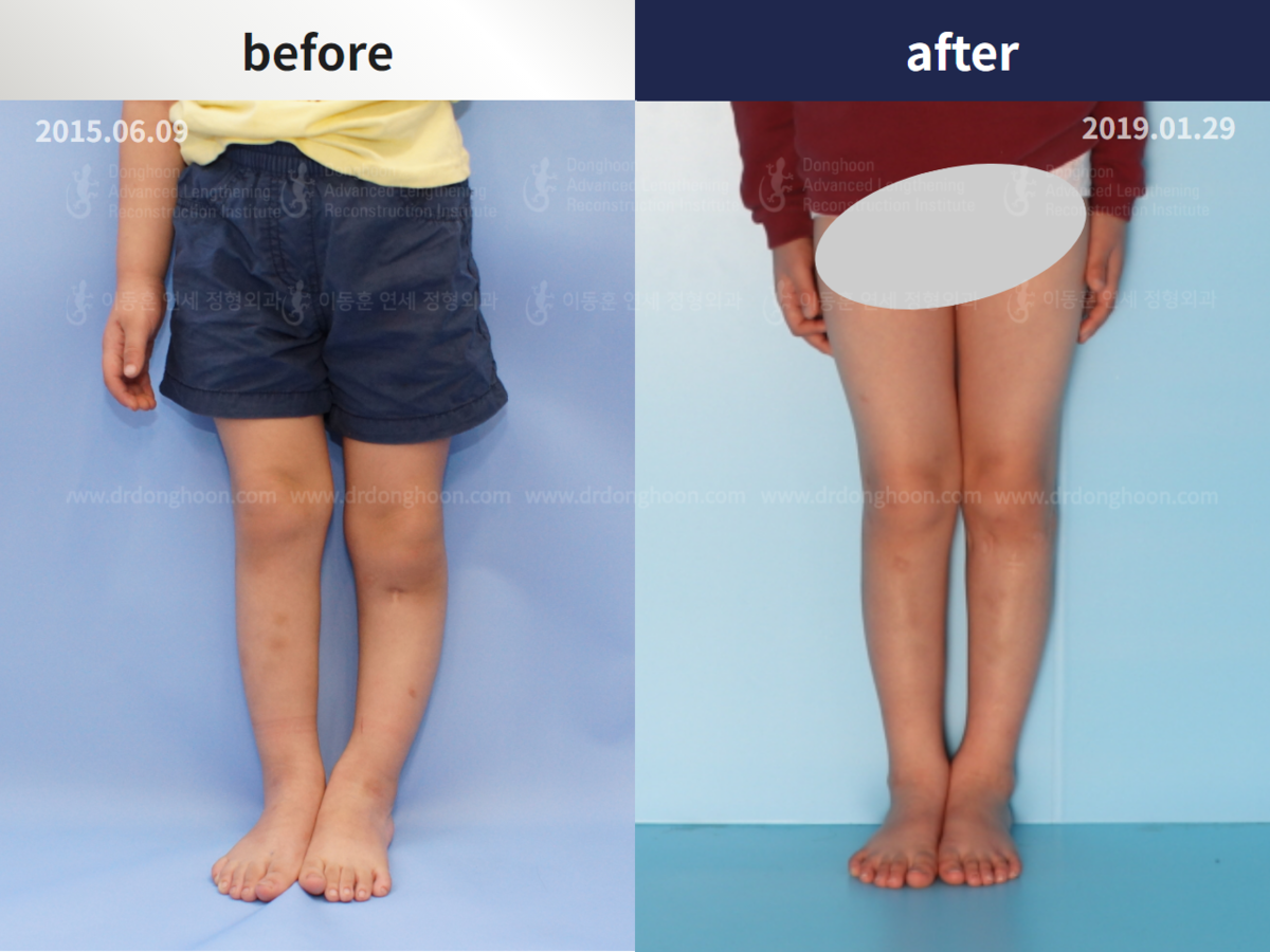 Blount disease bowlegs : Pediatric Congenital Condition