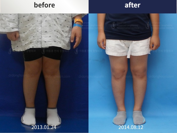 Paediatric & adolescent knock knees