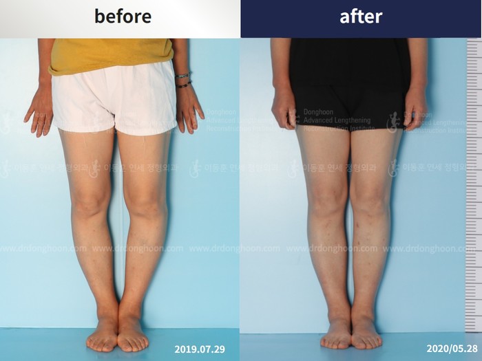 ผ่าตัดจัดแนวขาสำหรับเข่าเสื่อม