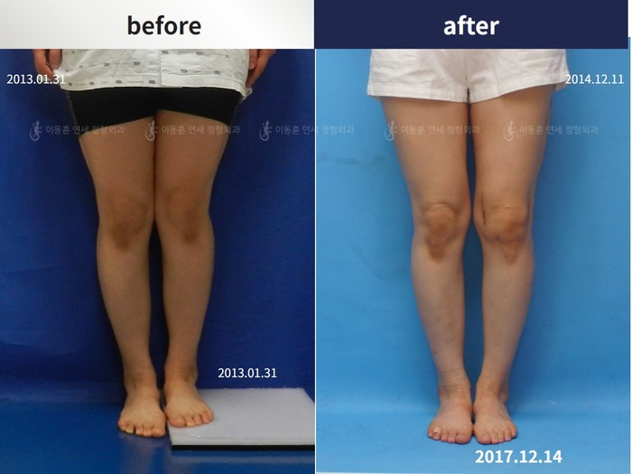Femoral lengthening