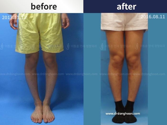 Tibial lengthening
