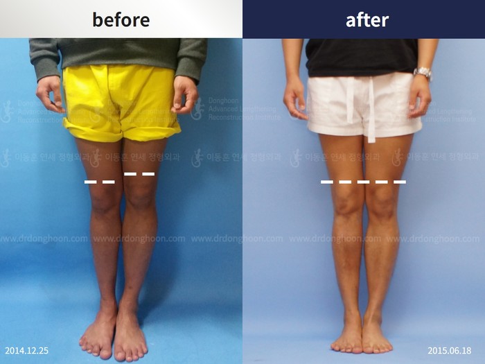 Tibial lengthening