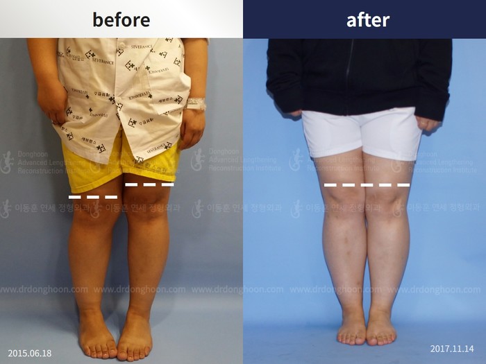 Tibial lengthening