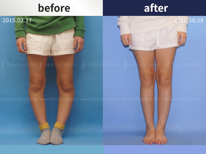 Tibial lengthening