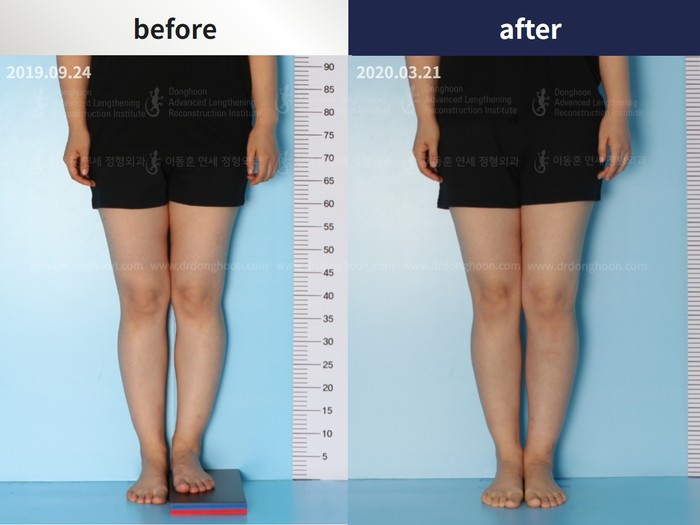 Tibial lengthening