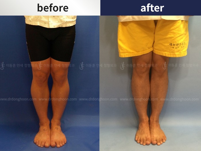 Tibial lengthening, 6 cm gained