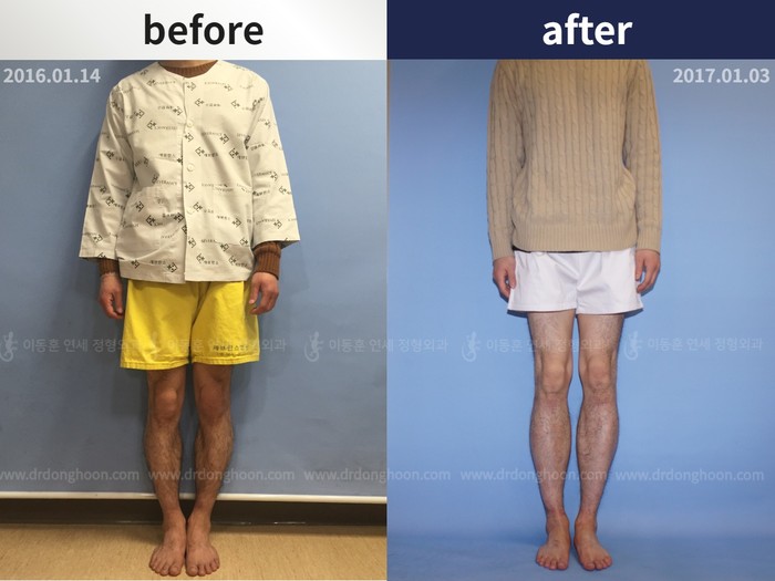 Tibial lengthening, 7 cm gained