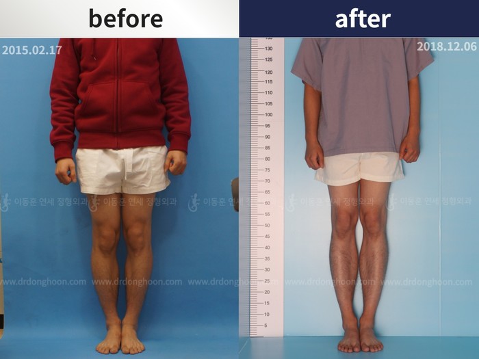 Tibial lengthening, 7 cm gained