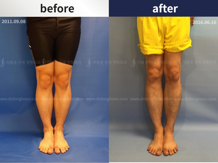 Tibial lengthening, 5 cm gained